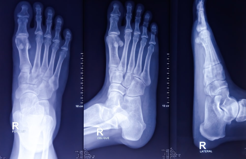 Multiple X-ray views of a right foot used to assess implant failure in Cartiva lawsuits.