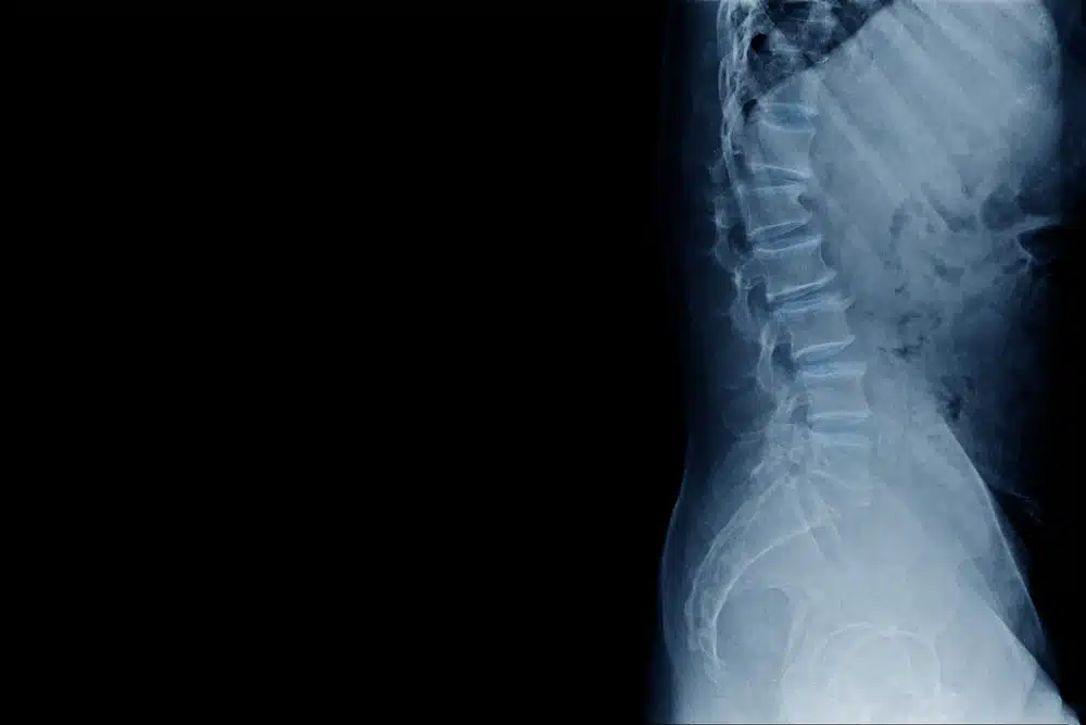 X-ray of the lower spine highlighting possible implant-related complications from a spinal cord stimulator.