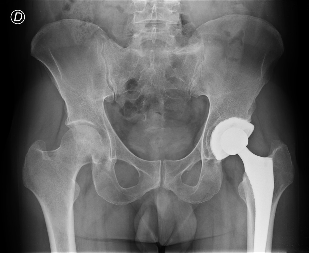 X-ray showing a hip implant device, illustrating complications linked to Zimmer Biomet hip replacements.
